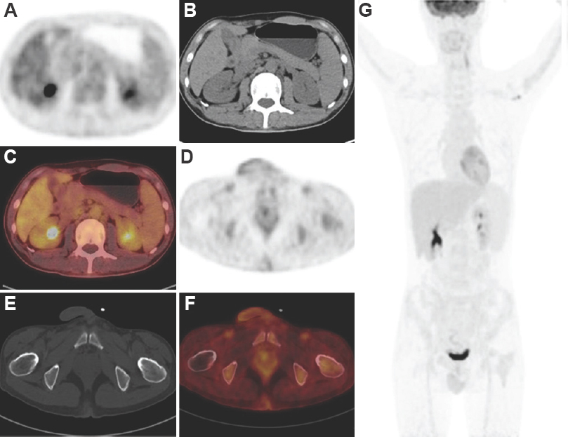After two cycles of chemotherapy, a repeat PET/CT showed that all previous hypermetabolic lesions disappeared. Panel A-C showed PET, CT, and PET/CT fusion images of both kidneys, respectively. Panel D-F showed PET, CT and PET/CT fusion images of the left femoral neck, respectively. (G) displayed MIP image of the whole body.