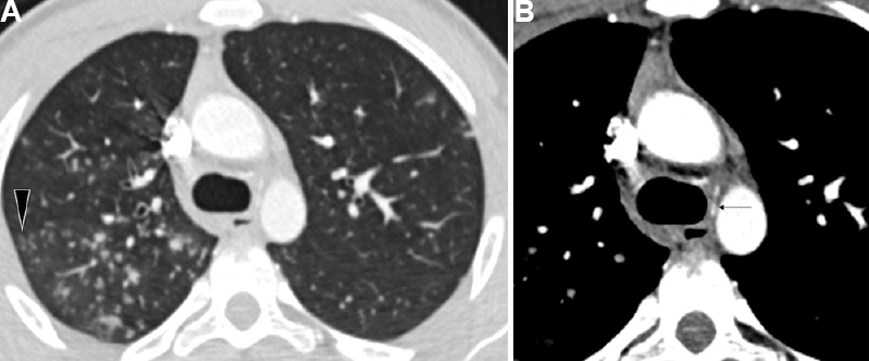 Active tubercular infection in a 16 yr old boy presenting with haemoptysis. (A) CT lung window images show multiple tree-in-bud nodules (arrowhead). (B) DECTA (mediastinal window) revealed no hypertrophied bronchial arteries. A normal caliber common bronchial artery trunk could be identified (arrow). DECTA, dual energy contrast enhanced multidetector row computed tomography angiography; CT, computed tomography.