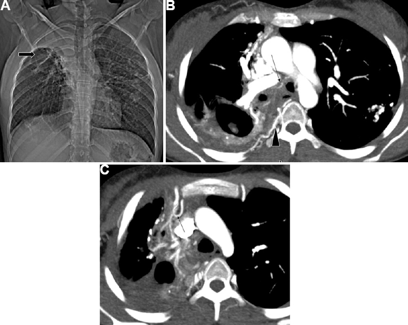 Post-infectious sequelae in a 16 yr old girl in a case of treated tuberculosis. (A) CT topogram – Volume loss with fibrocavitary changes in right upper zone (arrow) with fibrocalcific changes in the left lung. (B and C) DECTA shows the same along with hypertrophied bronchial arteries (arrow), multiple posterior intercostal arteries (arrowhead) and branches from the right internal mammary artery (arrow in c) (non-bronchial systemic collaterals).