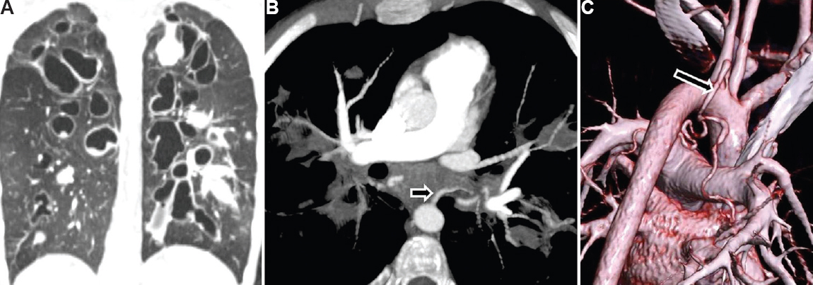 Cystic fibrosis with bronchiectasis in a 15 yr old boy presenting with moderate haemoptysis. (A) CT lung window shows bilateral central tubular/varicose bronchiectasis with multiple mucoceles. (B) DECTA shows dilated left bronchial artery (arrow). (C) Volume rendered image shows dilated common bronchial artery (arrow) arising from arch of aorta just adjacent to origin of left subclavian artery. The child underwent bronchial artery embolization for control of haemoptysis.