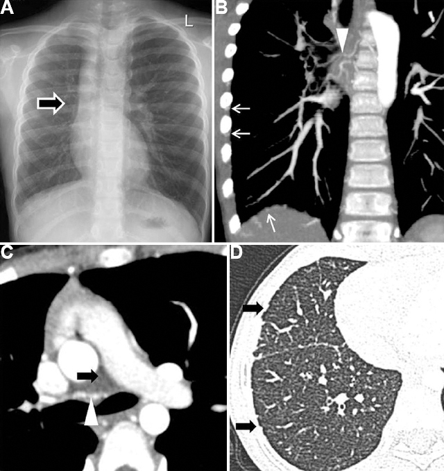 Aplasia of pulmonary artery/proximal interruption of the right pulmonary artery in a 10 yr old girl presenting with haemoptysis. (A) CXR- Small right hemithorax with absent right hilar opacity (arrow). (B and C) DECTA - Absent right PA (black arrow) and multiple hypertrophied bronchial (arrowhead) and non-bronchial systemic collaterals from inferior phrenic and intercostal arteries (white arrow). (D) Lung window shows the irregularity of the subpleural regions and fissures due to hypertrophied systemic collaterals supplying the lung (arrows).