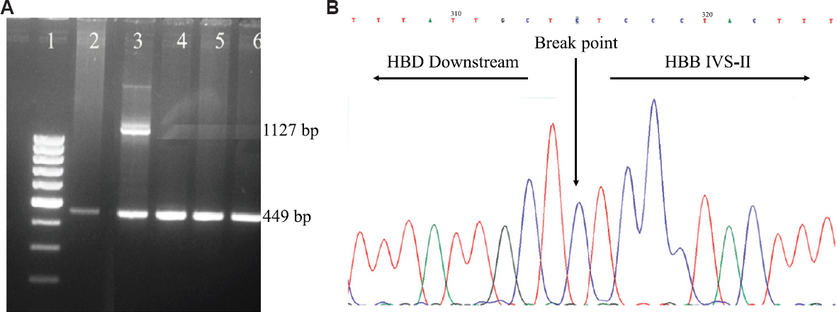 (A) 1.5 per cent agarose gel showing amplified products of gap-PCR. Lane 1: 100 bp ladder. Lane 2, 4, 5, 6: Normal control, showing the presence of control band of 449 bp. Lane 3: Sample heterozygous for 4056 bp deletion showing an internal control band of 449 bp and a mutant band of 1127 bp. (B) Automated DNA sequencing of the patient harbouring 4056 bp deletion in heterozygous condition. The electropherogram shows the breakpoint position of the 4056 bp deletion.