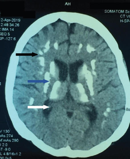 Non-contrast CT of brain with diffuse brain parenchymal (black arrow), basal ganglia (blue arrow) and thalamic calcification (white arrow).