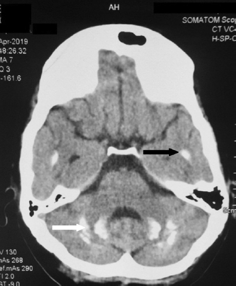 Non-contrast CT of brain with diffuse cerebellar (white arrow), temporal lobe calcifications (black arrow).