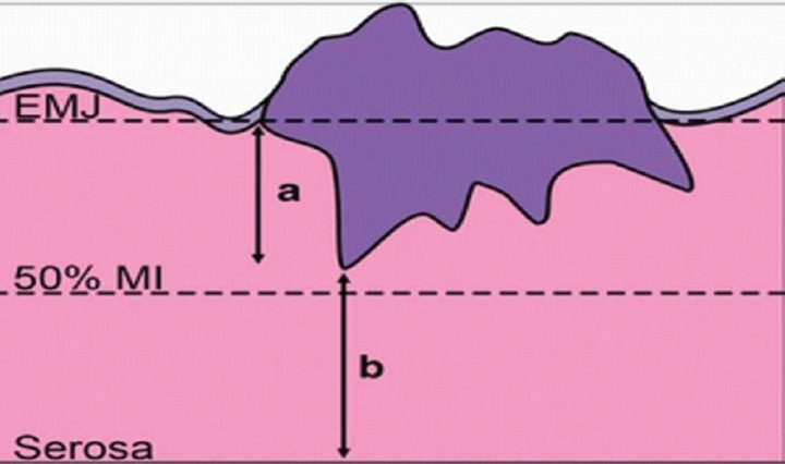 Figure showing pictographic representation of depth of invasion (DOI); tumour-free distance (TFD) and myometrial invasion percentage (MI%). a, depth of invasion; b, tumour-free distance from serosa; EMJ, endomyometrial junction.