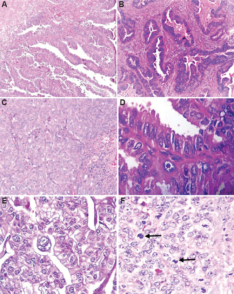 Histological pattern (A) papillary (H & E, x100); (B) glandular (H & E, x200); (C) solid (H & E, x200); (D) nuclear pleomorphism; (E) multinucleate giant cells and; (F) mitosis (black arrow; H & E, x400).