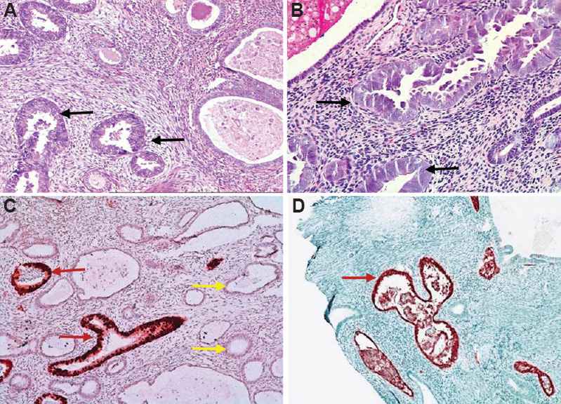 (A and B) Endometrial intraepithelial carcinoma arising in an endometrial polyp (black arrow; H & E, x200); (C and D) strong expression of p53 protein in the neoplastic glands (red arrow). Weak staining pattern is noted in the benign glands (yellow arrow).