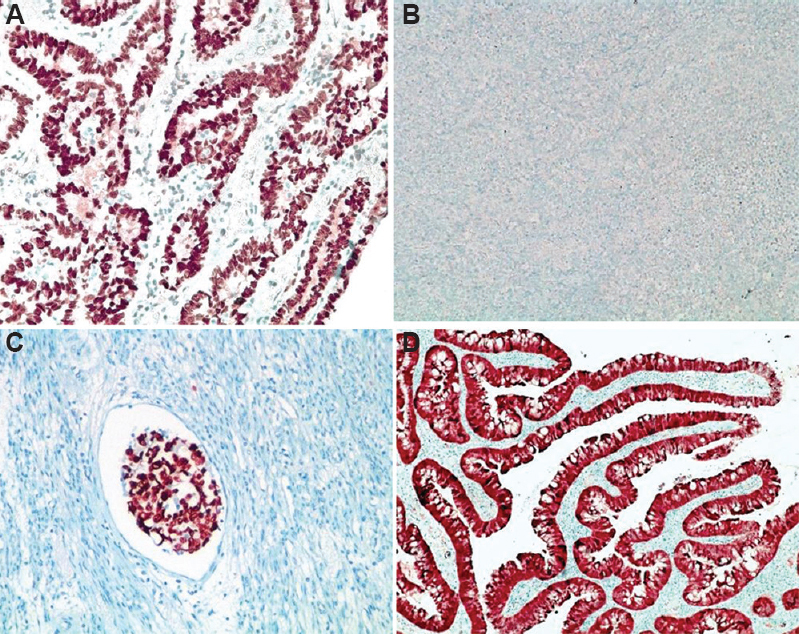 (A) Diffuse and strong nuclear positivity for p53 protein (mutation type); (B) Absent staining of p53 protein (null type); (C) strong p53 expression in lymphatic emboli; (D) diffuse nuclear and cytoplasmic staining for p16.