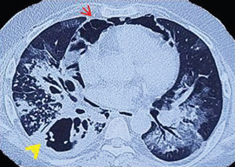 Computed tomography thorax demonstrating cavitary lesion in the lower lobe of the right lung (yellow arrowhead) and air around the heart (red arrow) suggesting a diagnosis of pneumomediastinum.