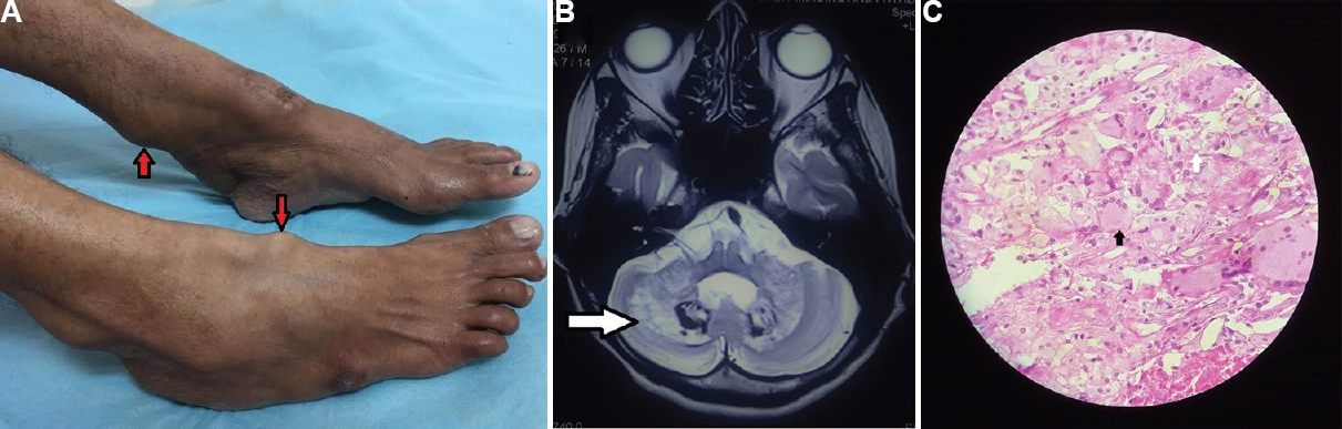(A) Firm globular tendon xanthomas without overlying skin changes over both ankles and feet (arrows), (B) T2-weighted magnetic resonance imaging showing high-signal intensity areas in the bilateral dentate nuclei and cerebellar white matter (arrow), (C) histopathological examination of tendon xanthoma showing foamy histiocytes (arrow) admixed with giant cells (black arrow) having multiple nuclei arranged in a garland-like fashion, with a large number of extracellular cholesterol crystals in the background conclusive of tendon xanthomas (H and E stain, ×100).