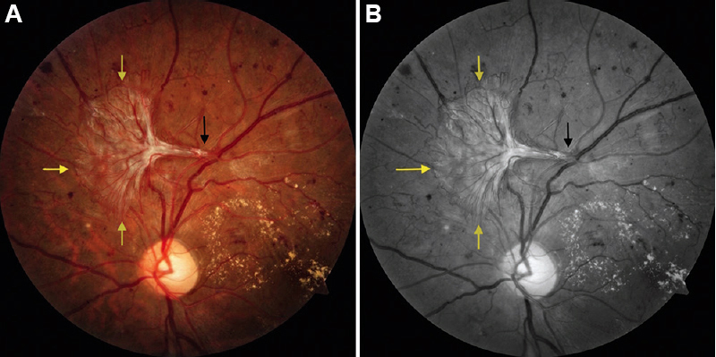 Fundus image (A) and red-free photograph (B) of left eye showing a large frond of Sea-fan neovascularization (yellow arrows) with a fleshy stalk originating from major retinal vessel (black arrow). Multiple small neovascularizations and circinate ring of hard exudates are also seen.