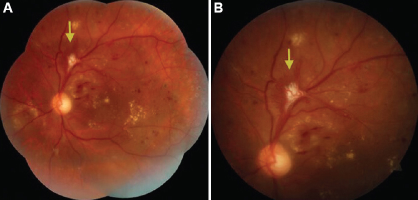 Montage fundus photograph (A) and enlarged superior fundus field (B) of the left eye at follow up showing peripheral laser scars and partial regression of Sea-fan neovascularization (yellow arrow).