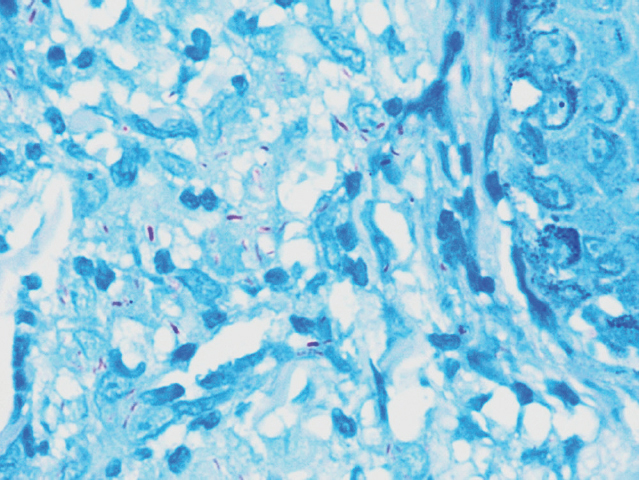 Acid-fast bacilli (ZN stain, ×100).