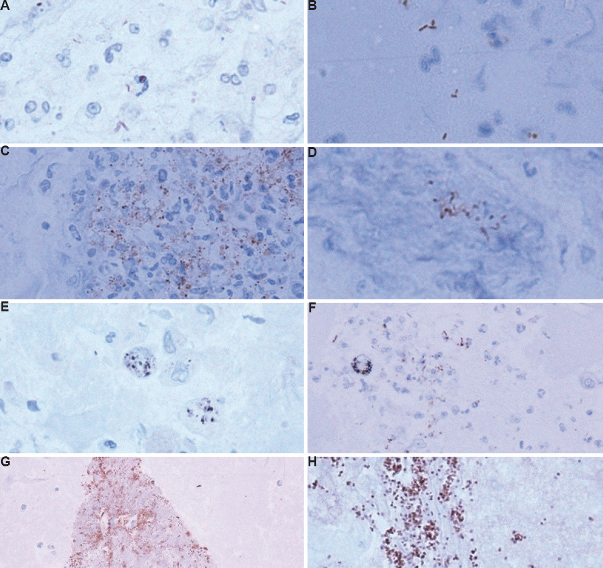 (A) Weak IHC positivity showing bacilli in clusters (×100). (B) Extracellular, stubby, dark bacilli, possibly contaminant (×100). (C) IHC positive bacilli entrapped in cluster of histiocytes and neutrophils (×40). (D) Cluster of IHC positive bacilli (×100). (E) Macrophages showing intracellular black anthracotic pigment (IHC, ×100). (F) IHC-positive bacilli and central macrophage showing blackish intracellular anthracotic pigment (×40). (G) Contaminant, (IHC, x40) (H) Dark brown course granularity, false positive (IHC, ×40) IHC, immunohistochemistry.