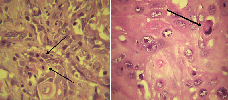Apoptotic cells (arrows) in oral squamous cell carcinoma (methyl green-pyronin, ×400).