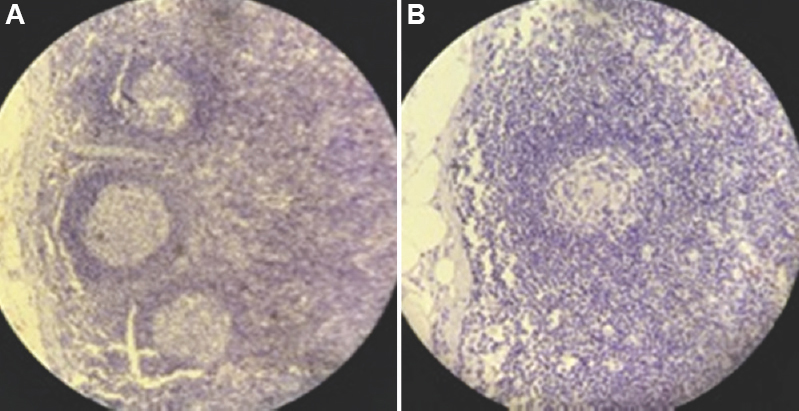Photomicrograph showing IHC (cytokeratin cocktail, AE1/AE3) stained lymph nodes with secondary follicles and germinal centres with characteristic absence of micro-metastatic deposit (A) ×20, and (B) ×40 magnification. IHC, immunohistochemistry.
