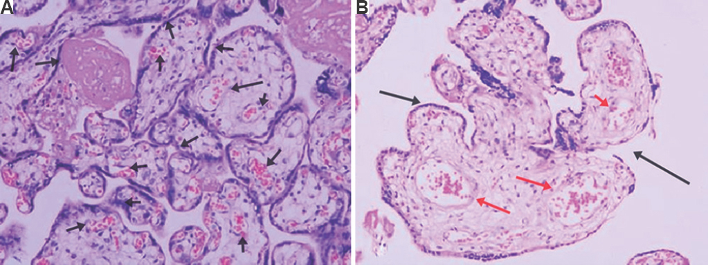 Histopathological findings of the placenta of controls (normal pregnancy) and cases (pre-eclampsia). Haematoxylin and eosin stain (×20 magnification). (A) Normal women’s placenta shows mature term villi with an increased number of villous vessels and formation of vasculosyncytial membranes (arrows). (B) Pre-eclamptic women’s placenta show smaller villi for the gestational age and lesser in number with reduced villous vessels (black arrow) and fibrotic stroma (red arrows). A significant increase in the number of cytotrophoblastic cell hyperplasia was also seen (n=10).