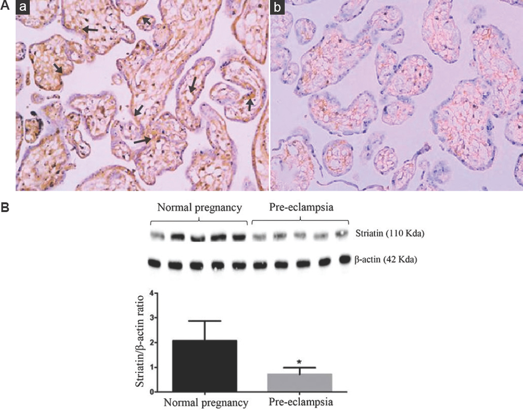 (A) Representative immunostaining of striatin (brown) in placental tissues from (a) normal, and (b) pre-eclampsia groups (×20 magnifications). Normal placenta showed increased striatin expression around the syncytiotrophoblast layer and perivascular layer. Pre-eclamptic women’s placenta shows decreased striatin cellular expression, particularly around the perivascular layer, and was absent in the syncytiotrophoblast layer (n=3). (B) Western blot analyses of striatin in placental tissues from normal women and those with pre-eclampsia (n=5). P *<0.05 compared to normal placenta.