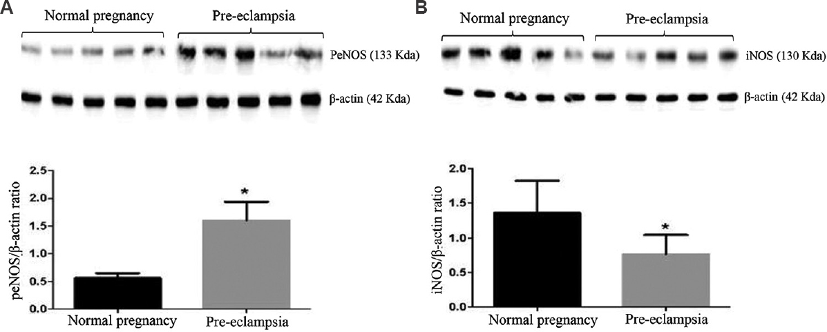 Western blot analyses of (A) peNOS, and (B) iNOS in placental tissues from normal women and those with pre-eclampsia (n=5). P *<0.05 compared to normal placenta. peNOS, phosphorylated endothelial nitric oxide synthase; iNOS, inducible nitric oxide synthase