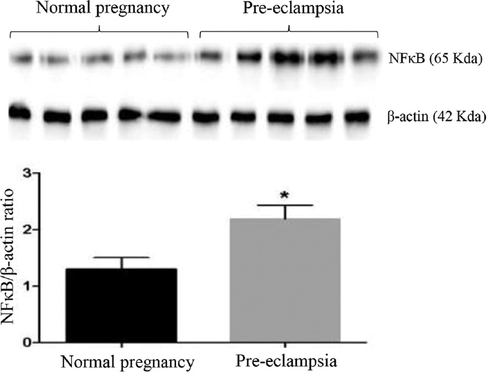 Western blot analyses of NF-κB in placental tissues from normal women and those with pre-eclampsia (n=5). P *<0.05 compared to normal placenta.