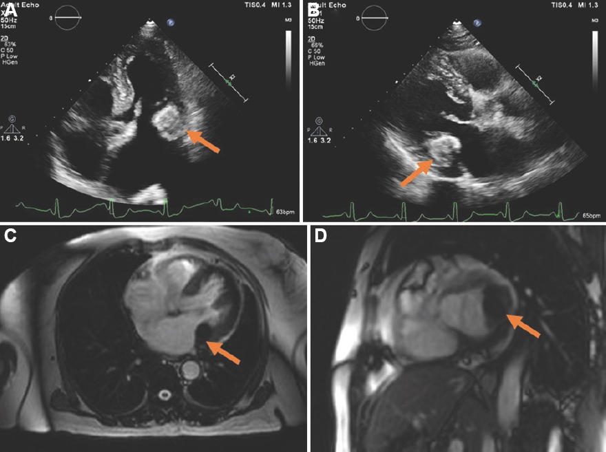 (A) Apical four-chamber echocardiographic view showing well-defined homogenous hyperechoic mass from posterior mitral leaflet (arrow) with dilated left atrium. (B) Parasternal long-axis echocardiographic view showing calcified mitral leaflet (arrow). (C) T1-weighted magnetic resonance imaging in four-chamber view depicting hypointense focal lesion from mitral leaflet (arrow). (D) Short axis of magnetic resonance imaging showing calcified mitral leaflet and adjoining annulus (arrow).
