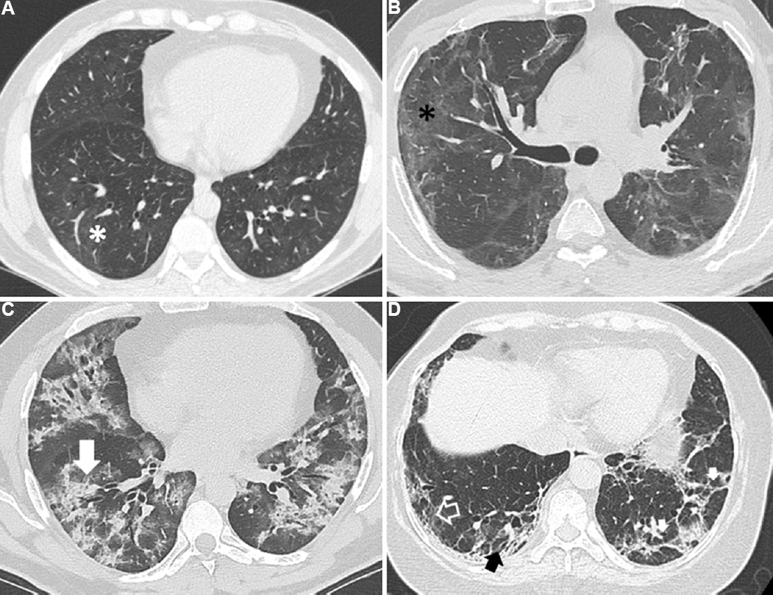 Representative images of thin-section computed tomography (CT) scans of the chest showing various radiological abnormalities in study participants. (A) Subtle ground glass opacities (asterisk) affecting <20 per cent of the lung parenchyma in a subject without clinically significant diffuse parenchymal lung abnormalities; (B) Ground glass opacities (asterisk) and parenchymal bands affecting ≥20 per cent of lung parenchyma; (C) Chest CT showing predominantly consolidation (arrow) and ground glass opacities; (D) Chest CT showing areas with parenchymal bands (small solid white arrows), reticulation (open arrow) and traction bronchiectasis (black arrow).
