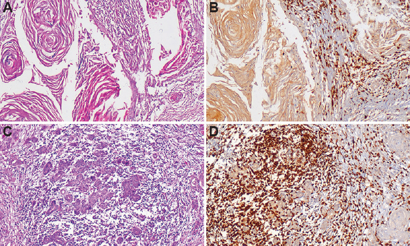 Photomicrographs of oral squamous cell carcinoma (OSCC). Section of metastatic OSCC tissue showing (A) invading tumour islands and keratin pearls (H & E, ×100), (B) staining with CD3 antibody showing weak nuclear staining (IHC, ×100). Section of non-metastatic OSCC tissue showing (C) small invading tumour islands (H & E, ×100), (D) staining with CD3 antibody showing strong nuclear staining (IHC, ×100).