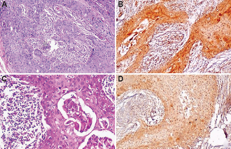 Photomicrographs of OSCC. Section of metastatic OSCC tissue showing (A) invading sheets of tumour (H & E, ×100). (B) stained with anti-VEGF antibody showing strong cytoplasmic staining (IHC, ×100). Section of non-metastatic OSCC tissue showing (C) invading tumour islands (H & E, ×100). (D) weak cytoplasmic staining (IHC, ×100).