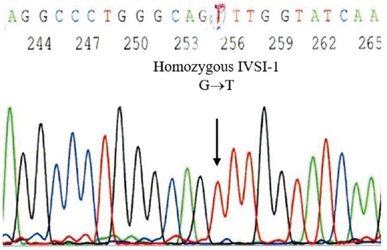 The results of the direct DNA sequencing technique applied to DNA samples from amniotic cells, which are consistent with the NIPT-formulated diagnosis of an at risk foetus homozygous for beta-thalassaemia IVS1-1 G→T. NIPT, non-invasive prenatal testing