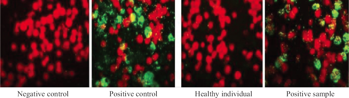 Images of immunoglobulin M indirect immunofluorescence assay (x 400 magnification).