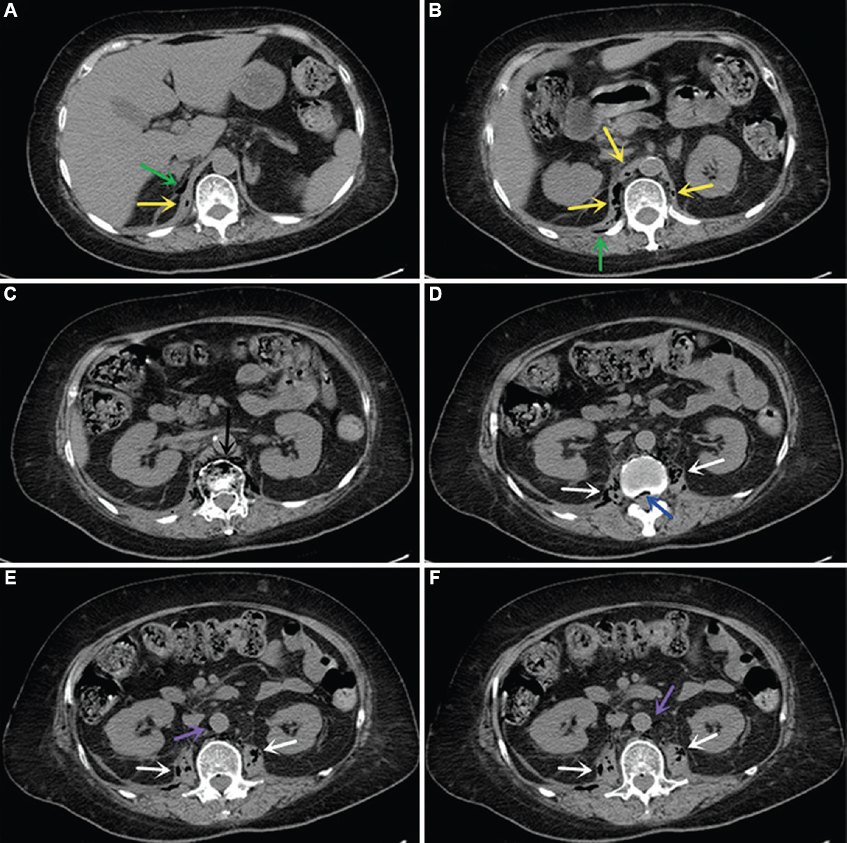 Axial CT images showing pneumatosis in diaphragm (Panels A and B, yellow arrows) and surrounding space (Panels A and B, green arrows), vertebra and paravertebral space (Panel C, black arrow), intraspinal canal (Panel D, blue arrow), bilateral psoas (Panels D-F, white arrows) and para-aortic space (Panels E and F, purple arrows). CT, computed tomography.