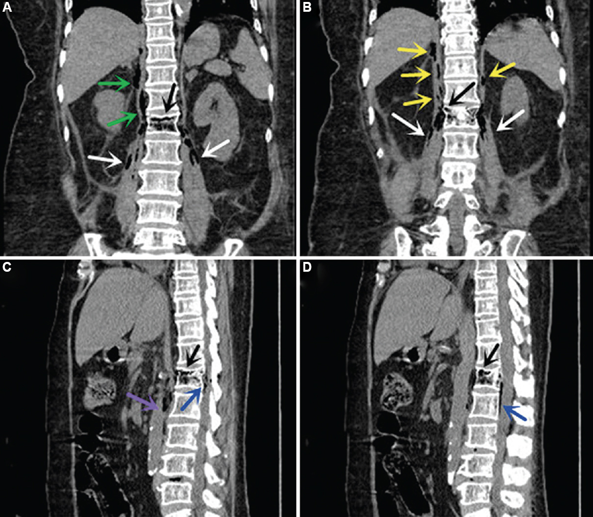 Coronal and sagittal CT images using multi-planar reformatting showing emphysematous infection in the diaphragm (Panel B, yellow arrows) and surrounding space (Panel A, green arrows), vertebra (Panels A-D, black arrows), intraspinal canal (Panels C and D, blue arrows), bilateral psoas (Panels A and B, white arrows) and para-aortic space (Panel C, purple arrow). CT, computed tomography.