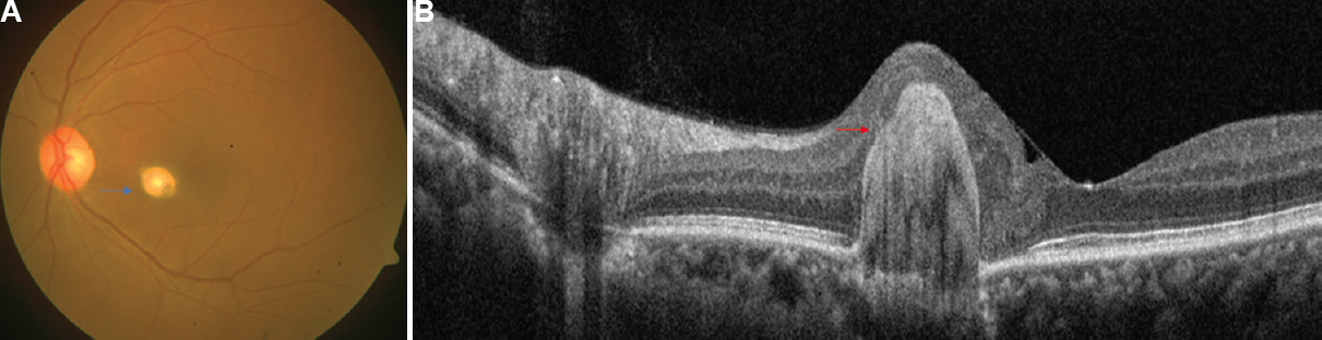 (A) Fundus photograph of the left eye showing a yellowish-white, pearl-shaped lesion (blue arrow), nasal to the foveal centre. (B) Swept source optical coherence tomography scan showing a hyper-reflective lesion involving the outer retina and retinal pigment epithelium with sparing of inner retinal layers, the tapered appearance of the lesion (red arrow) resembles the superior part of ‘Space-X’ space shuttle.
