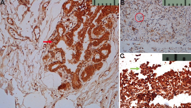 (A) Nuclear and cytoplasmic expression of BRCA1 (red arrow) seen in normal TDLU (DAB, ×200). (B) Faint cytoplasmic expression in <25 per cent of tumour cells is seen, tumour cells are encircled as compared to normal TDLU in (A) (DAB, ×200). (C) Strong nuclear and cytoplasmic expression (green arrow) in >75 per cent of tumour cells as compared to normal TDLU in (A) (DAB, ×400) TDLU, terminal duct lobular unit