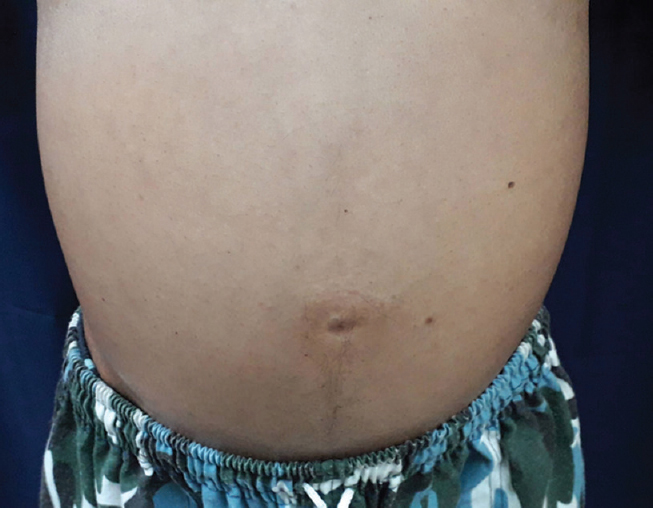 Abdominal distension due to ascites.