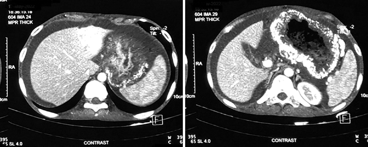 Axial cuts of CECT scan of the abdomen showing full-thickness calcification of the gastric wall along with ascites. CECT, contrast-enhanced computed tomography.