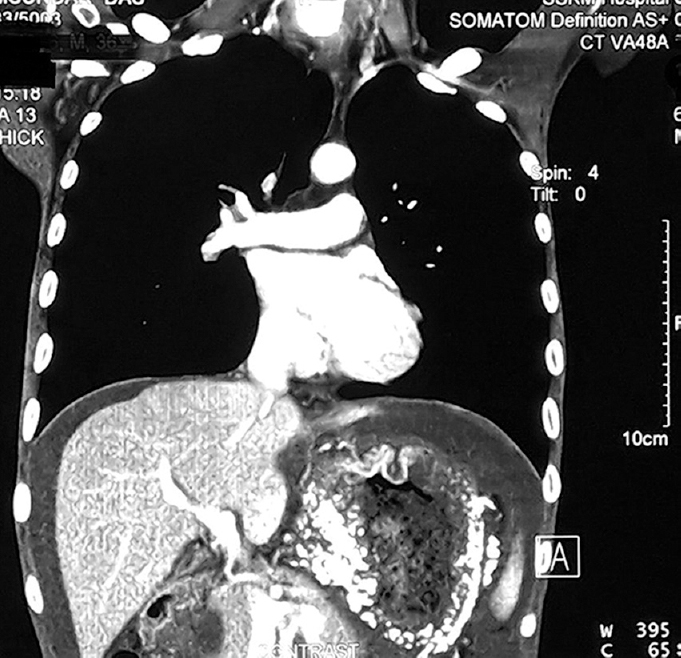 Coronal cuts of CECT scan showing calcification of the entire stomach wall. CECT, contrast-enhanced computed tomography.