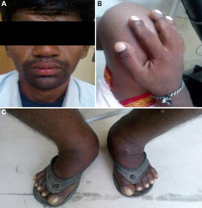 (A) Coarse facial skin with marked cutis gyrate (grade 2 pachyderma), heavy eyelids with ptosis, blepharoptosis and seborrhoea with oily facial skin. (B) Clubbing of hand. (C) Significant swelling over legs and ankle joints with clubbing.