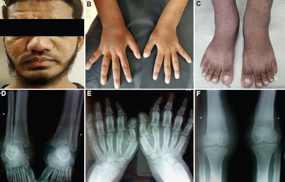(A) Grade 1 to 2 pachyderma with excessive sweating with facial furrowing. (B) Clubbing of hands. (C) Ankle joint swelling. (D) Diaphyseal expansion, periosteal reaction and rarefaction of spongiosa with coarse trabeculation in the distal end of tibiae and fibulae. (E) Diffuse sclerosis seen in the lower end of radius and ulna with cortical sclerosis. (F) Cortical thickening, sclerosis of the tubular bones with the marked periosteal reaction of the distal end of the femur and proximal tibia.