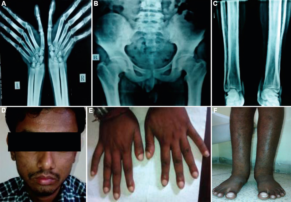 (A) Diffuse sclerosis and the periosteal reaction seen in the lower end of radius and ulna with the transverse sclerotic band. (B) Sclerotic bands along the inferior margin of iliac bones with coarse trabeculation of the iliac wings. (C) Cortical thickening, diaphyseal widening and periosteal reaction along shafts of long bones of legs. (D) Grade 1 pachyderma with thickening of facial skin without facial puckering. (E) widening of tips of fingers with grade 5 clubbing. (F) Bilateral leg and ankle joint swelling with clubbing.