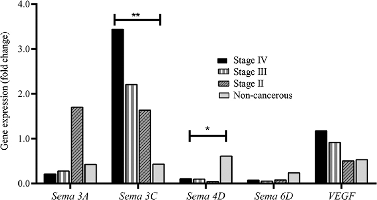 Semaphorins gene expression and tumour stage of LSCC. Data are presented as median. (P*<0.05, **<0.01 vs. non-cancerous).