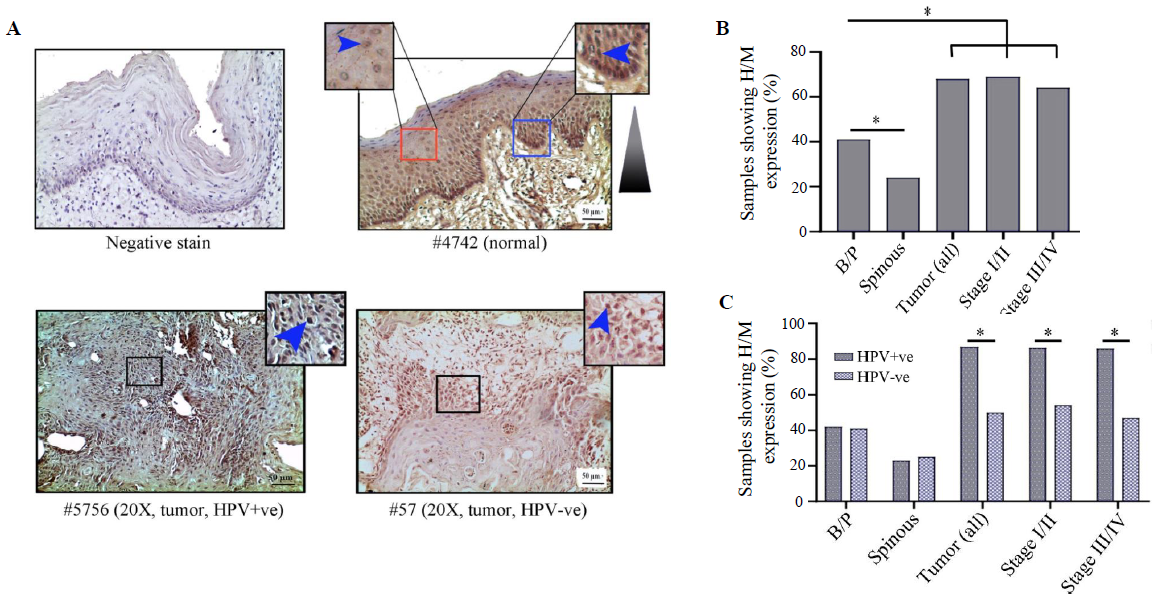 Immunohistochemical analysis of HIFα protein in HPV+ve/–ve tumours and adjacent normal oral epithelium. (A) Representative image of expression pattern (nuclear) of HIF1α in different layers (B/P and spinous layers) of adjacent normal epithelium and HPV+ve/HPV–ve tumour tissue samples. Inset showing high-power view of the same. (B) The bar graph represents H/M expression of HIF1α in different layers of adjacent normal and tumour tissues of different clinical stages, irrespective of HPV infection status. (C) Bar graph represents HPV infection specific H/M expression pattern of HIF1α in different layers of adjacent normal and tumour tissues of different clinical stages. Blue arrows and blue gradient triangles indicate nuclear expression and nuclear expression pattern, respectively (P*<0.05). B/P, basal/parabasal layers; H/M, high/medium.