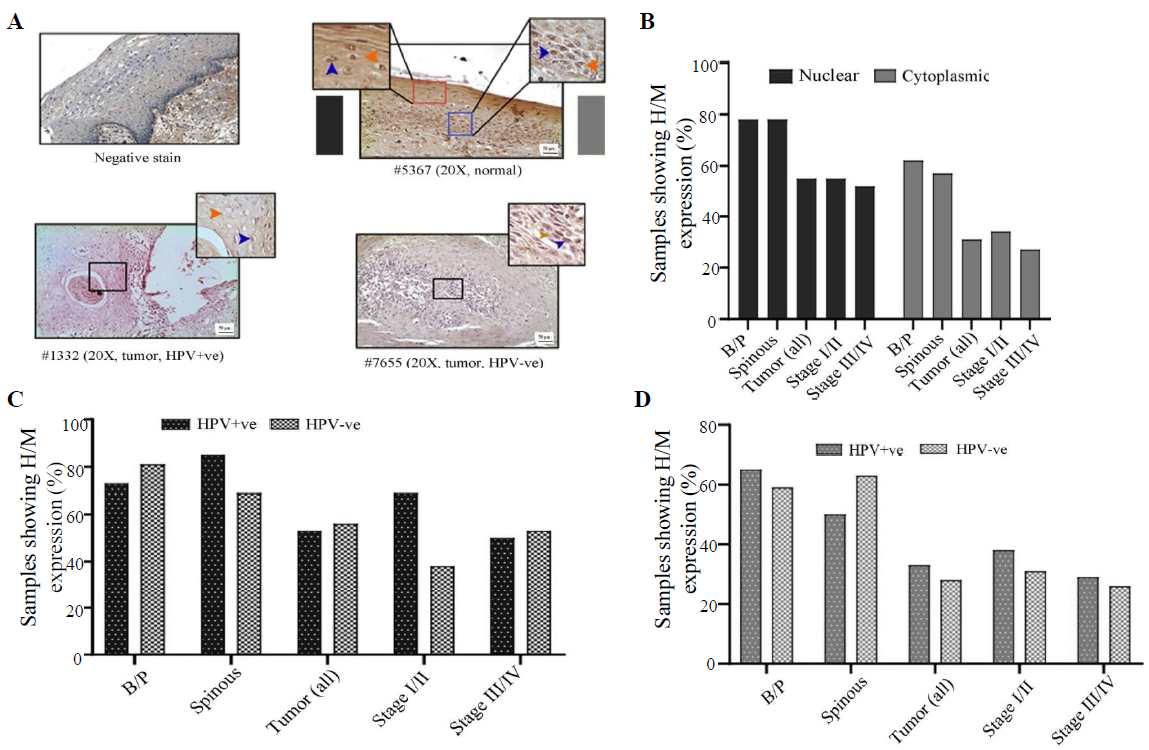 Immunohistochemical analysis of LIMD1 protein in HPV+ve/–ve tumours and adjacent normal oral epithelium. (A) Representative image of the expression pattern (nuclear/cytoplasmic) of LIMD1 in different layers (B/P and spinous layers) of adjacent normal epithelium and HPV+ve/HPV–ve tumour tissue samples. The insets are showing high-power view of the respective image. (B) The bar graph represents H/M expression of LIMD1 in nuclear and cytoplasmic compartments in different layers of adjacent normal and tumours tissues of different clinical stages, irrespective of HPV infection status. (C and D) The bar graphs represent HPV infection specific comparative expression pattern of LIMD1 in nuclear and cytoplasmic compartments in different layers of adjacent normal and tumours tissues of different clinical stages. Blue and orange arrows indicates nuclear and cytoplasmic expression, respectively and grey gradient rectangle indicates nuclear/cytoplasmic expression pattern.