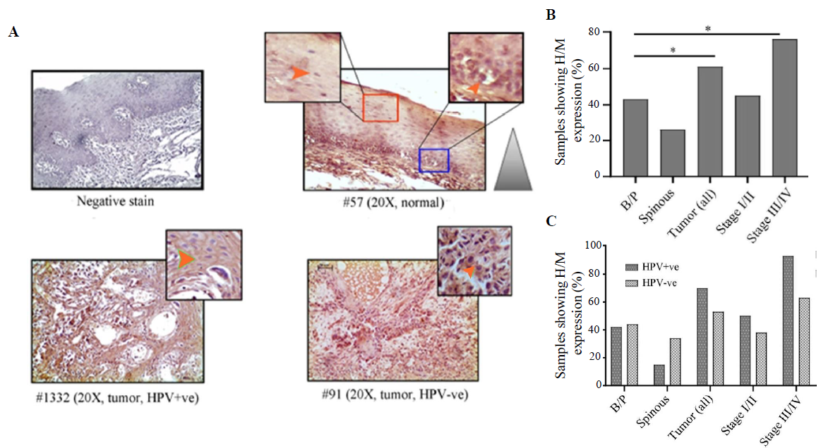 Immunohistochemical analysis of VEGF protein in HPV+ve/–ve tumours and adjacent normal oral epithelium. (A) Representative image of expression pattern (cytoplasmic) of VEGF in different layers (B/P and spinous layers) of adjacent normal epithelium and HPV+ve/HPV–ve tumour tissue samples. The insets are showing high-power view of the respective image. (B) The bar graph represents H/M expression of VEGF in different layers of adjacent normal and tumour tissues of different clinical stages, irrespective of HPV infection status. (C) The bar graph represents HPV infection specific H/M expression pattern of VEGF in different layers of adjacent normal and tumour tissues of different clinical stages. Orange arrows indicate cytoplasmic expression and grey gradient triangle indicates cytoplasmic expression pattern (P* <0.05).