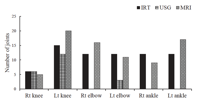 Comparison of IRT with USG and MRI findings. Results of three modalities were compared and depicted as composite bar-diagram. Results of all the three bilateral joints investigated by IRT, USG and MRI were compared. USG failed to detect bleeding in right elbow and ankle joints. No., number.