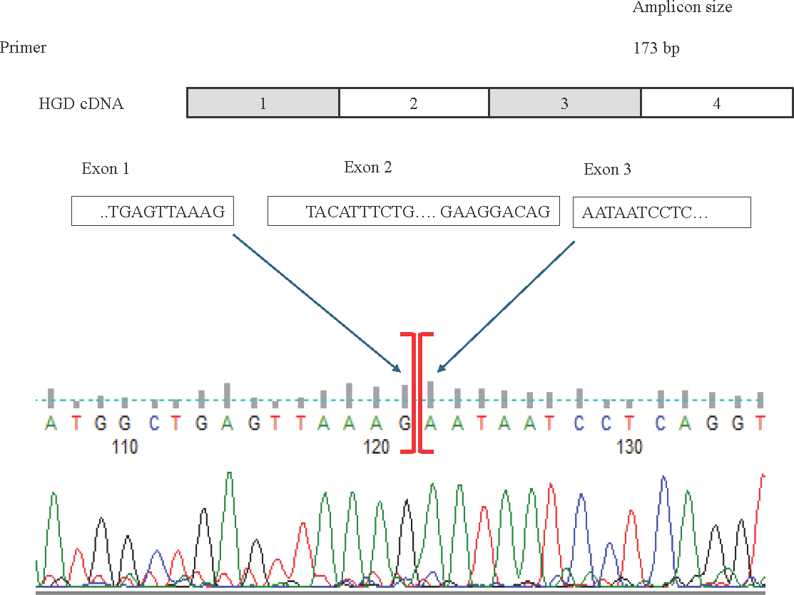 Top: The schematic representation of the location of the forward and reverse RT-qPCR primers spanning exons 1 to 3 in the normal HGD cDNA transcript. Below: HGD cDNA sequence showing exon 2 skipping in the affected individuals carrying the splice donor variant in comparison to the heterozygous (carriers) and the normal individuals (wildtype).