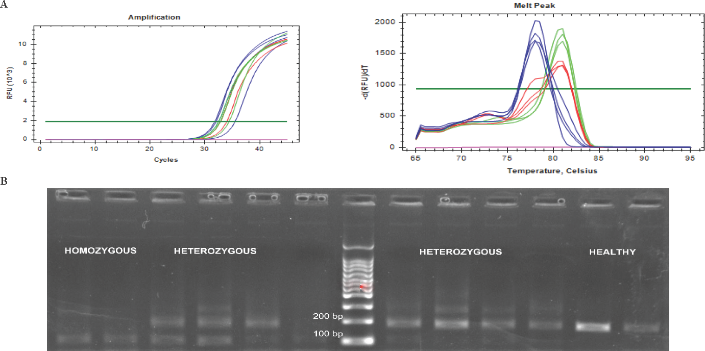 (A) Real time qPCR (RT-qPCR) amplification plots and the melting curve peaks of the homozygous (blue), heterozygous (red) and healthy individuals (green). Note the shift in the melt peak of the homozygous samples (at 78°C) in comparison to that of healthy samples (at 80.50°C). (B) The gel electrophoresis photo showing bands at 100 bp for the homozygous samples and at 173 bp for the healthy individuals. The heterozygous samples showed bands of both sizes.