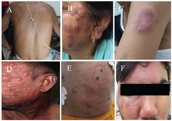 (A) Multiple symmetrical hypopigmented macules and plaques in borderline lepromatous leprosy. (B) Multiple plaques and nodules in a patient with borderline lepromatous leprosy. (C) A single annular erythematous plaque with central clearing in borderline tuberculoid leprosy. (D) Multiple nodular lesions in lepromatous leprosy with erythema nodosum leprosum. (E) Necrotic ulcers in erythema nodosum leprosum. (F) Borderline tuberculoid leprosy with type 1 reaction over face misdiagnosed as cellulitis.