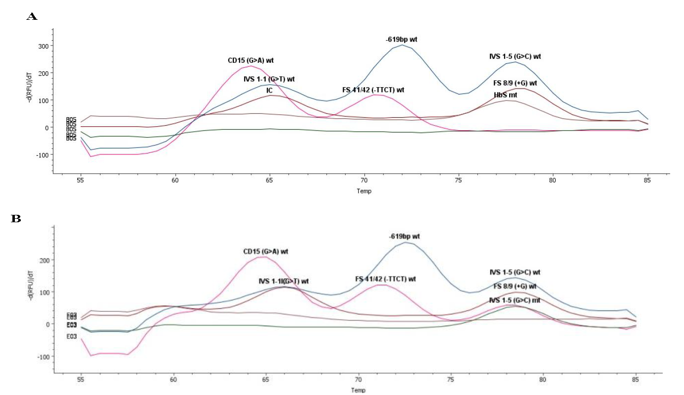 Melting-curve analysis showing a case of (A) HbS Homo mutation and (B) IVS1-5(G>C) hetero mutation.