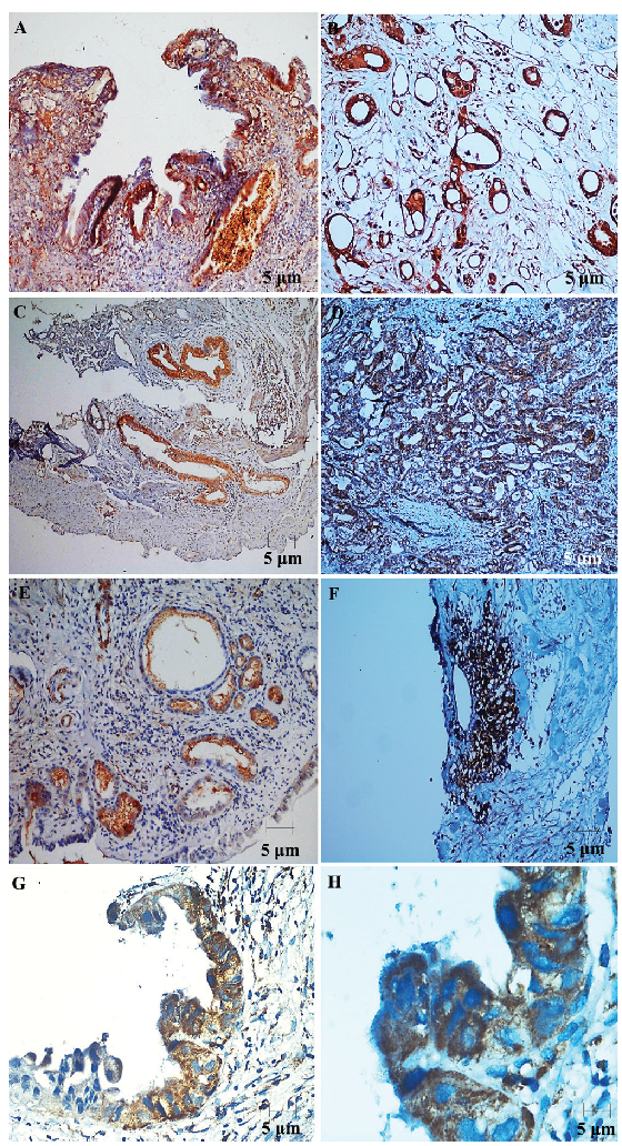 Immunohistochemistry of STAT and NFĸB in GBC and cholelithiasis. Representative immunohistochemistry (IHC) staining images illustrating the expression of STAT3, STAT6, and NFĸB in cholelithiasis and gallbladder adenocarcinoma. Panels (A), (C), and (E) show nuclear and cytoplasmic expression of STAT3, STAT6, and NFĸB in cholelithiasis, while panels (B), (D), and (F) depict the expression in gallbladder adenocarcinoma. Images (A), (C), (D), (E), and (F) are captured at 20× magnification, whereas image (B) is captured at 40× magnification. Additionally, panels (G) and (H) present representative images of STAT6 expression in gallbladder adenocarcinoma at 40× and 100× magnification, respectively, highlighting tumor cells exhibiting predominantly cytoplasmic and focal nuclear immunopositivity for STAT6.